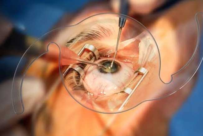 Cataract Surgeon in Goregaon and Jogeshwari