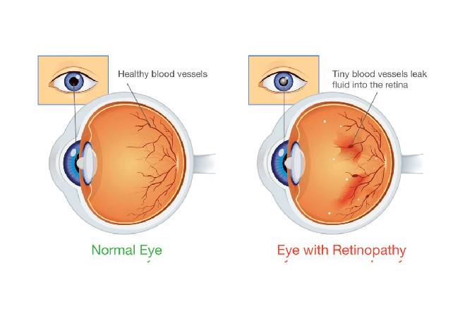Diabetic Retinopathy Treatment Goregaon West