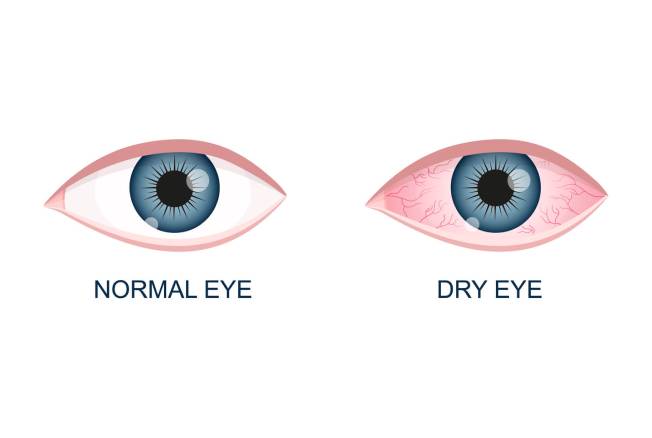 Dry Eye Treatment in Goregaon, Ram Mandir and Jogeshwari