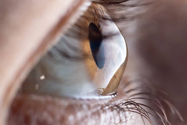 Keratoconus Treatment in Goregaon West