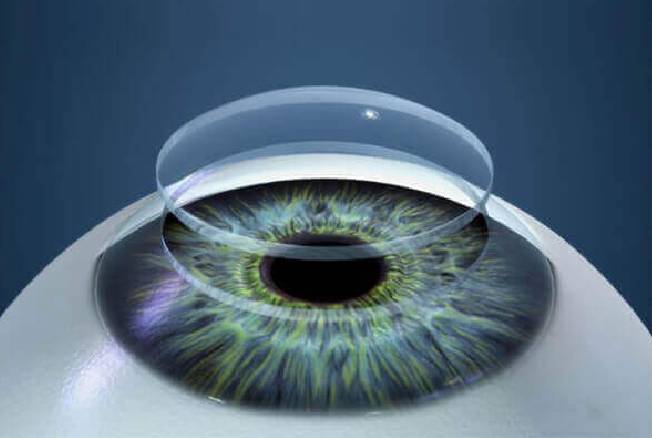 Corneal Transplant Surgeon in Goregaon West, Jogeshwari and Ram Mandir