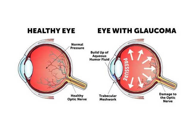 Glaucoma Treatment in Goregaon, Ram Mandir, Jogeshwari
